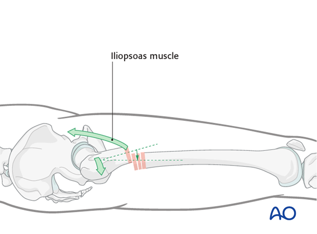 Antegrade nailing – Subtrochanteric femoral fracture – Reduction