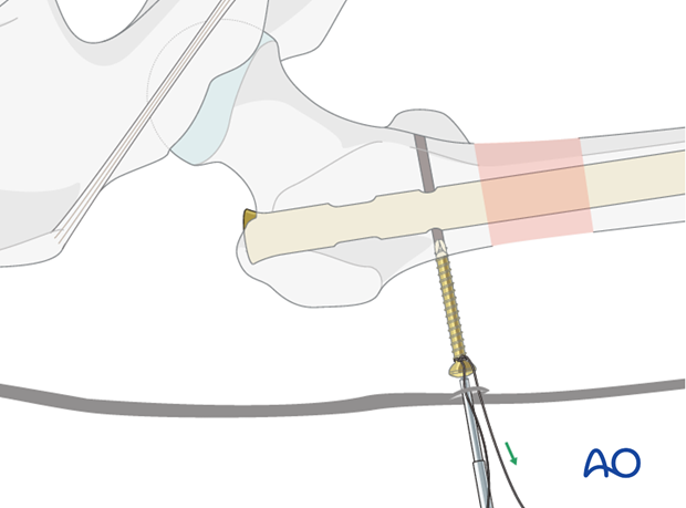 Antegrade nailing – Subtrochanteric femoral fracture – Nail locking - general considerations