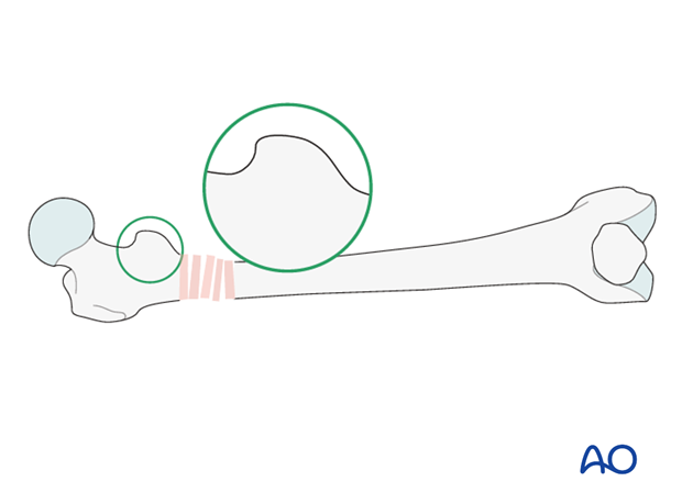 Antegrade nailing – Subtrochanteric femoral fracture – Intraoperative radiological assessment