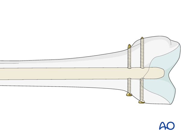 Femoral shaft – Antegrade nailing – Complete distal locking