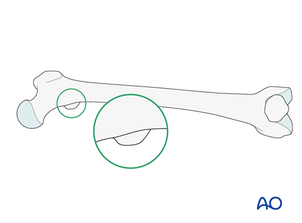 Antegrade nailing – Subtrochanteric femoral fracture – Intraoperative radiological assessment