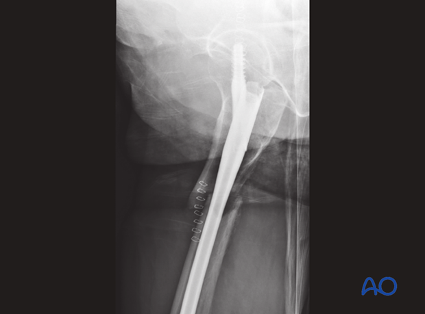 Antegrade nailing – Subtrochanteric femoral fracture – Assessing nail insertion