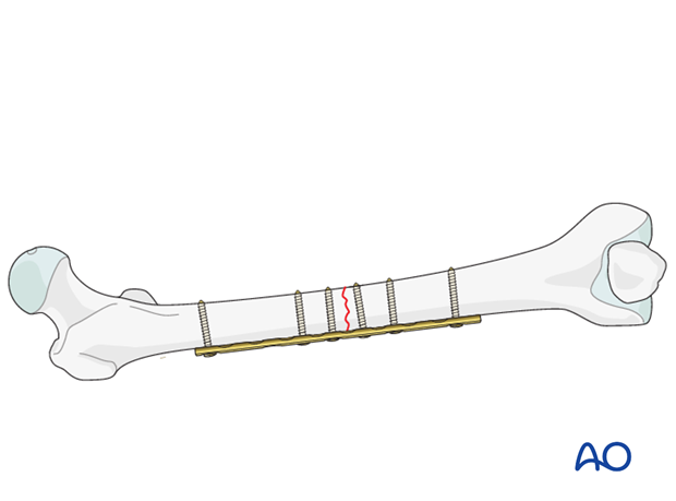 Transverse fracture of femoral shaft – Compression plate – Principles