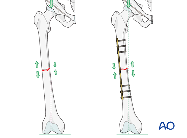 Transverse fracture of femoral shaft – Compression plate – Plate position