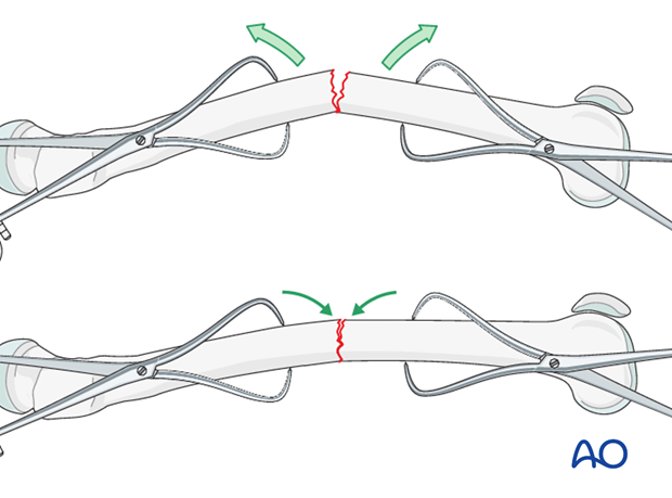 Transverse fracture of femoral shaft – Compression plate – Reduction