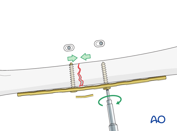 Transverse fracture of femoral shaft – Compression plate – Overbending the plate