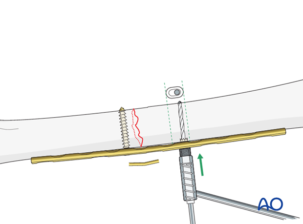 Transverse fracture of femoral shaft – Compression plate – Screw insertion