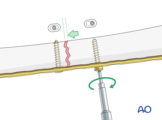 Transverse fracture of femoral shaft – Compression plate – Dynamic compression principle