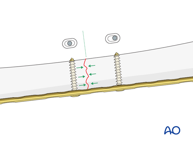 Transverse fracture of femoral shaft – Compression plate – Dynamic compression principle