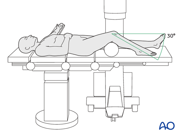 supine knee flexed 30