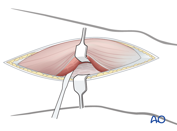 Elevation of the muscle fivers off the septum