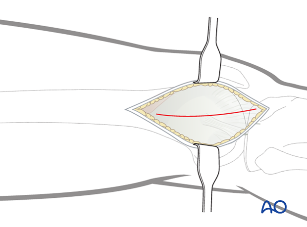 Division the iliotibial band (tract)