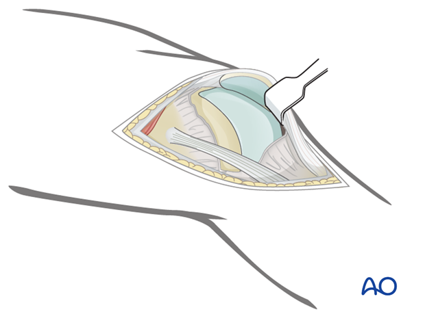 Incision of joint capsule Incision of joint capsule