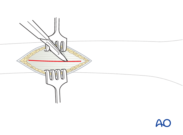 Incision of fascia lata