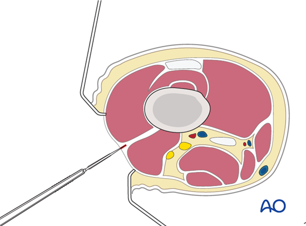 Exposure of vastus lateralis