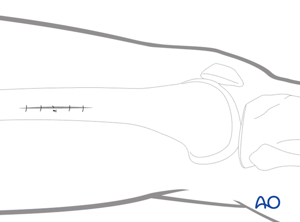 Closure of stab incisions