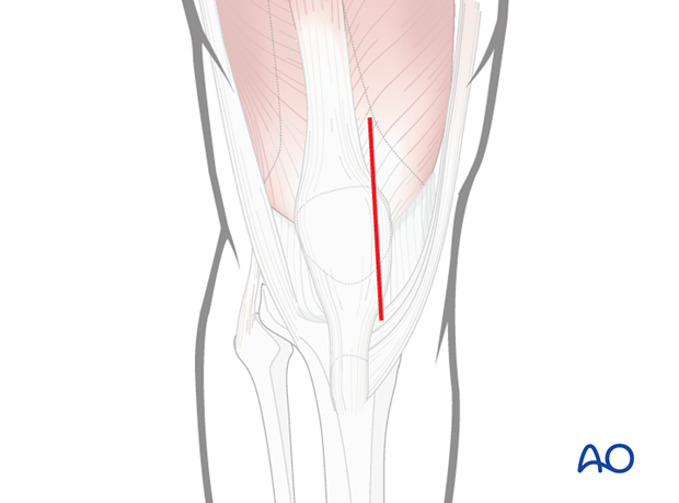 Skin incision