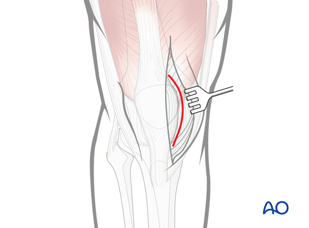 Opening of the knee joint