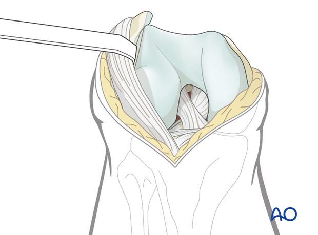 Reflection of the patella and extensor retinaculum