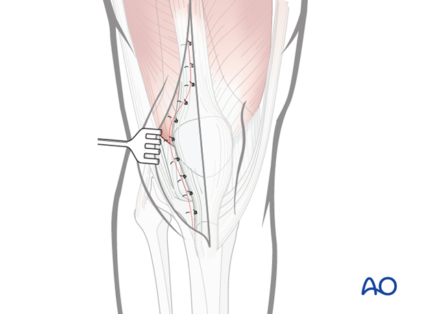 Wound closure