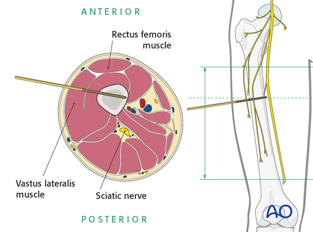 Safe zone in the midshaft of the femur – Lateral pin insertion