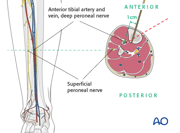 Safe zone in the midshaft of the tibia 