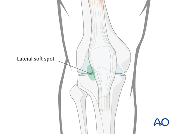 Anterolateral port location