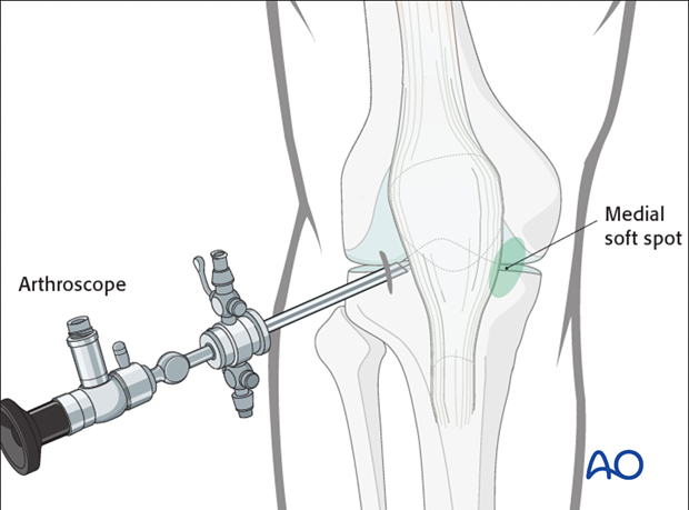 Anteromedial port location