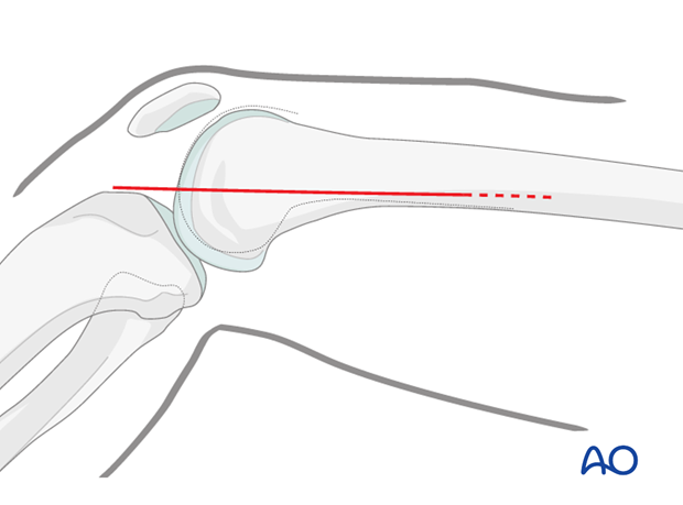 Skin incision made in the line of the tendon of adductor magnus