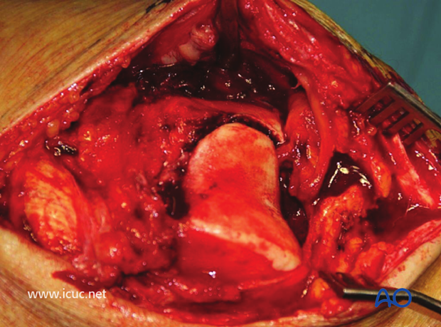 This image shows the patella retracted medially with the patellar tendon attached to the tibial tuberosity, but the whole of the distal femur can be visualized.