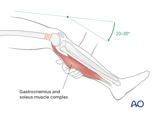 Release of muscle pull by knee flexion