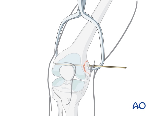 Insertion of K-wire