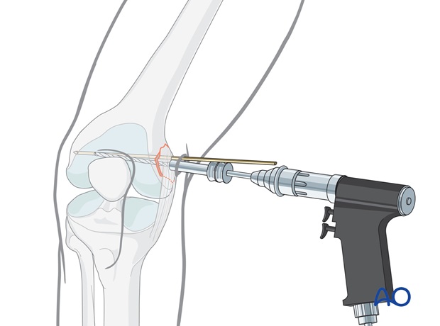 Drilling screw hole