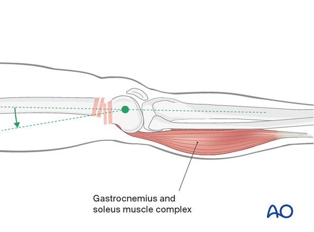 Muscle pull causing displacement of distal segment