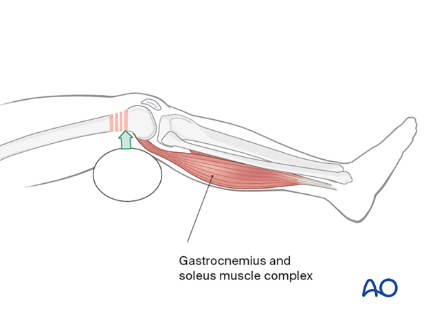 Correction of hyperextension deformity