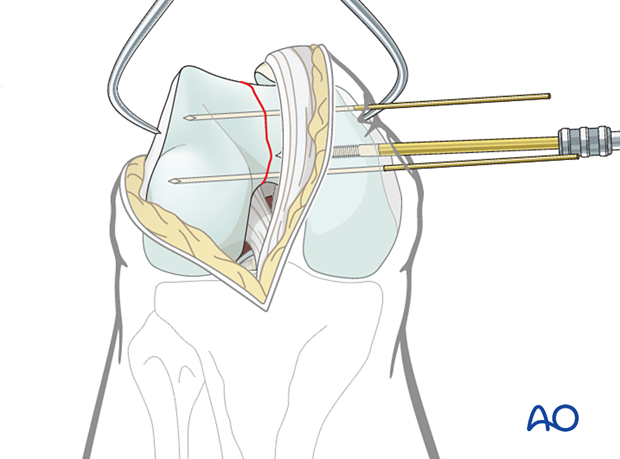 Provisional fixation of the articular block