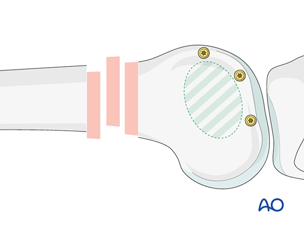 Definitive articular surface fixation of the articular block