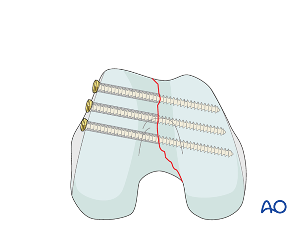 Screw trajectories distal articular block