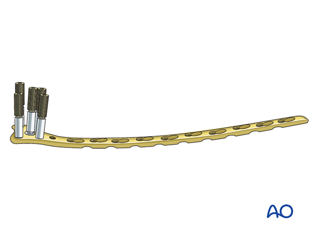 Assembly of Condylar LCP