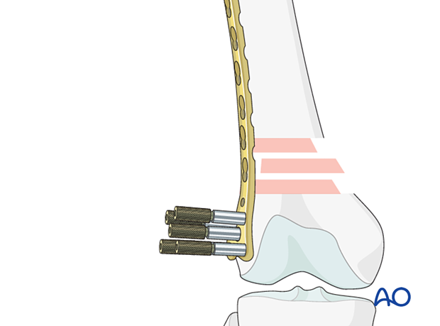 Frontal plane alignment Frontal plane alignment