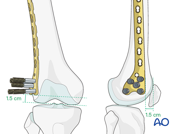 Position on the distal femur