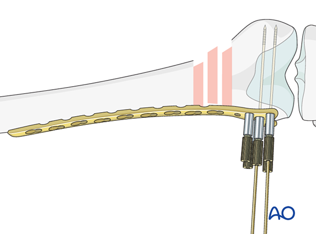 Insertion of second guide wire