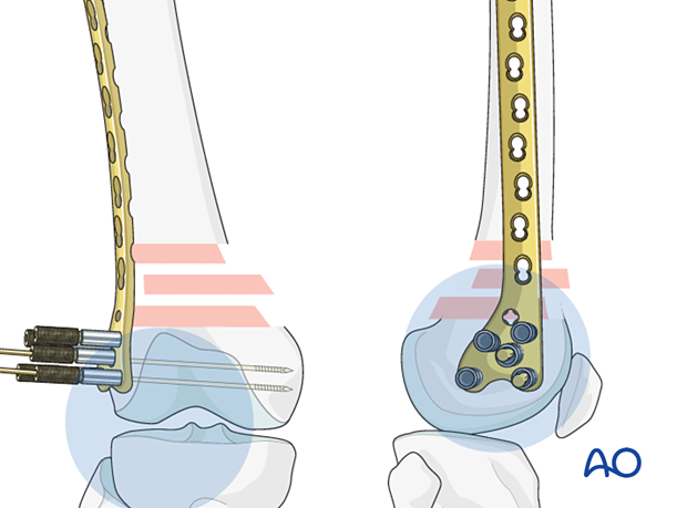 Confirmation of plate head placement, using visual examination and an image intensifier