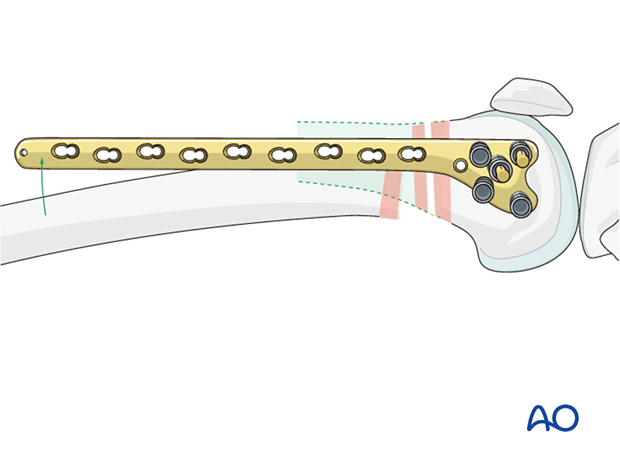 Confirmation of plate alignment