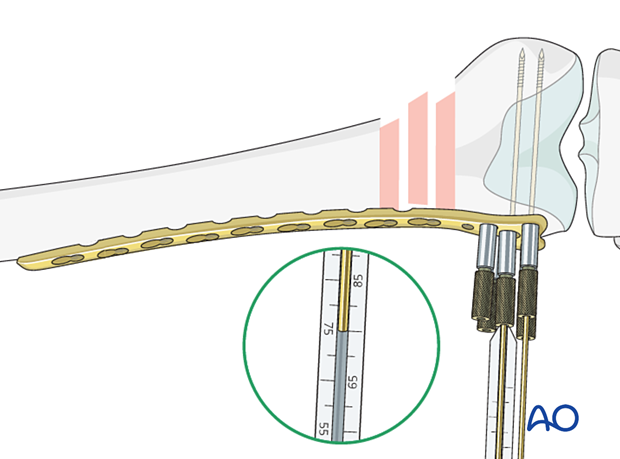 Screw length measurement in distal femoral articular block