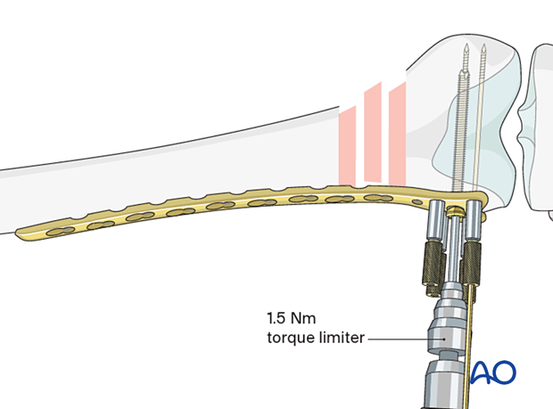 Distal screw insertion