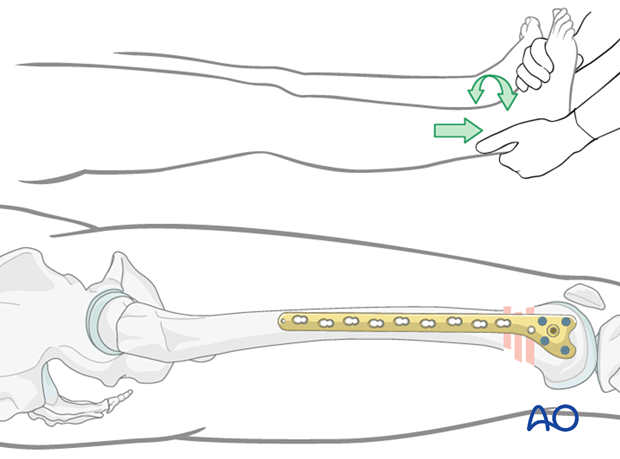 Restoration of length