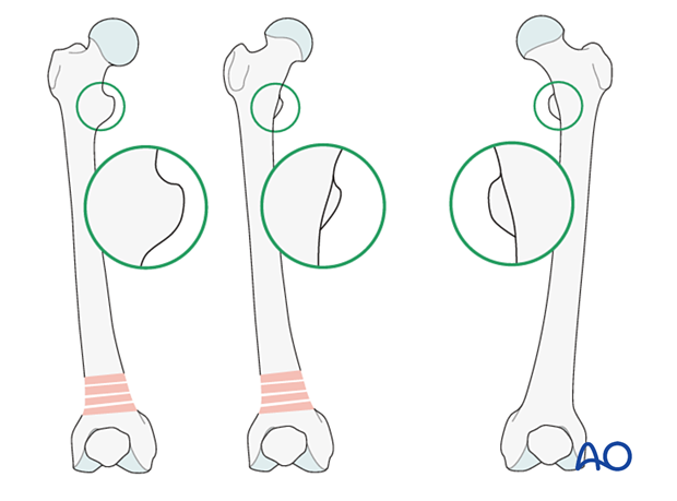 Indications of malrotation