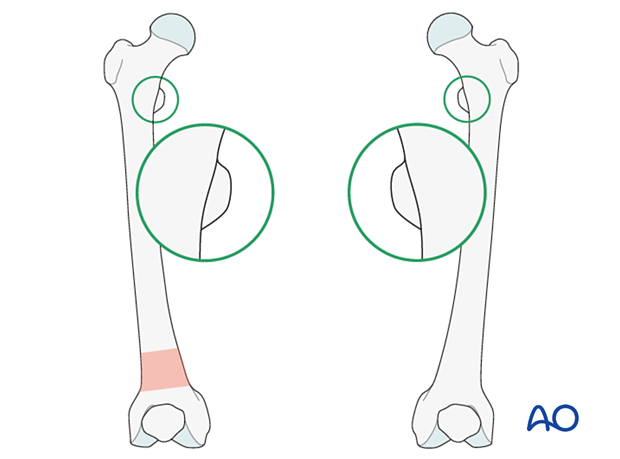 Matching of the lesser trochanter shape