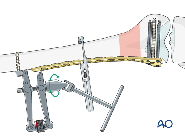 Application of the articulated tension device Application of the articulated tension device